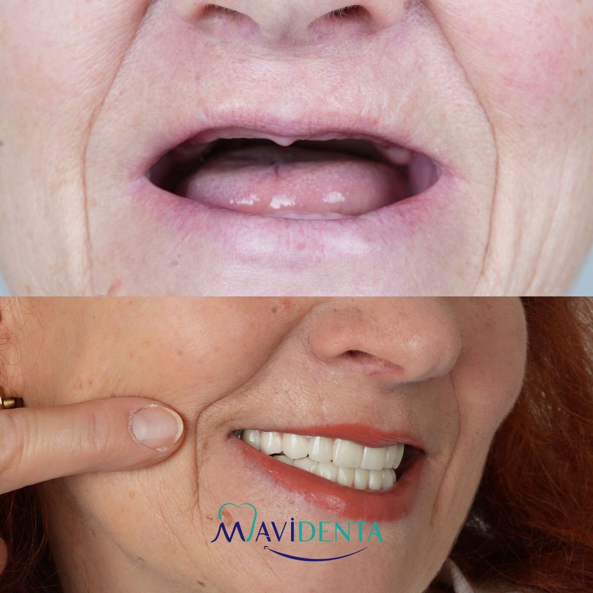 نتيجة قبل وبعد زراعة الأسنان All-on-6 في Good Look Clinic، استعادة الابتسامة الكاملة