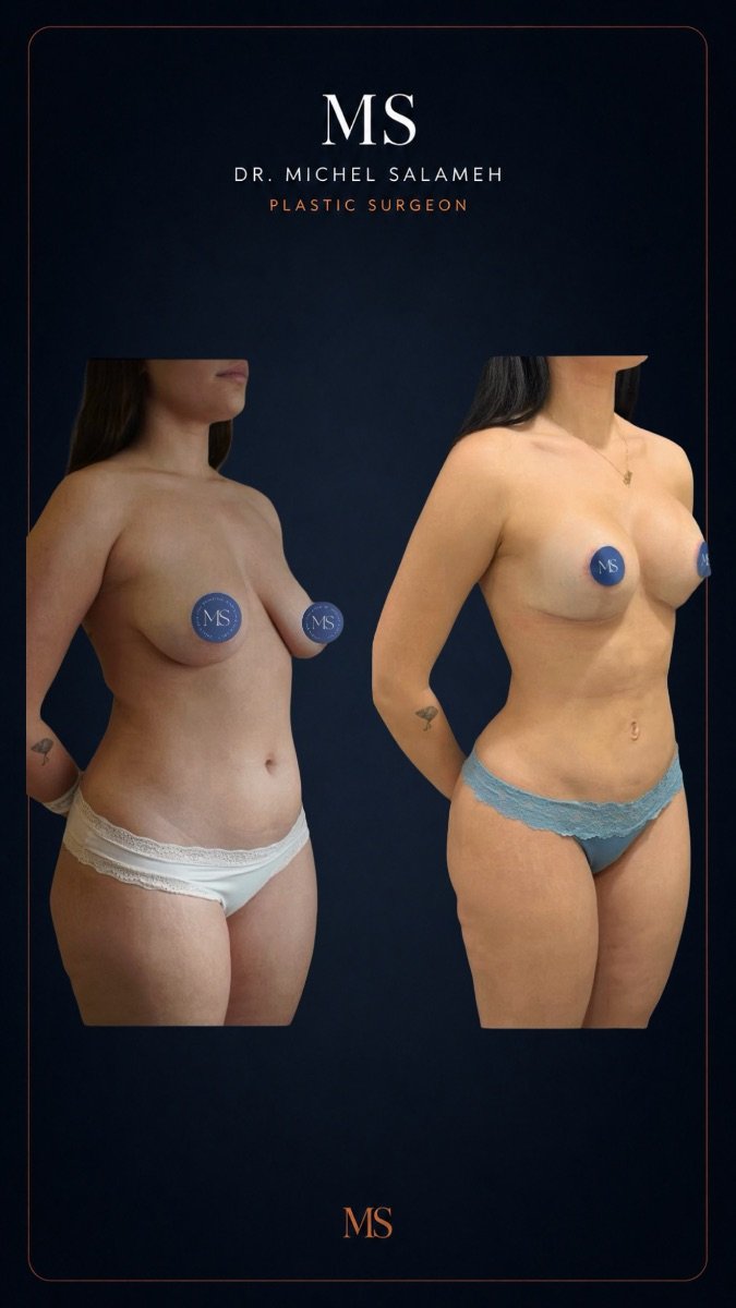 Resultados de liposucción 360 antes y después en Dr. Michel Salameh - Plastic And Aesthetic Surgery