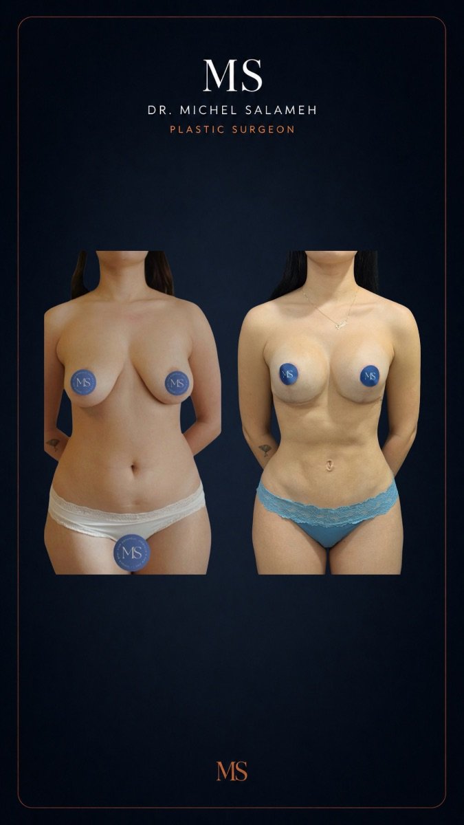 Resultados de liposucción 360 antes y después en Dr. Michel Salameh - Plastic And Aesthetic Surgery
