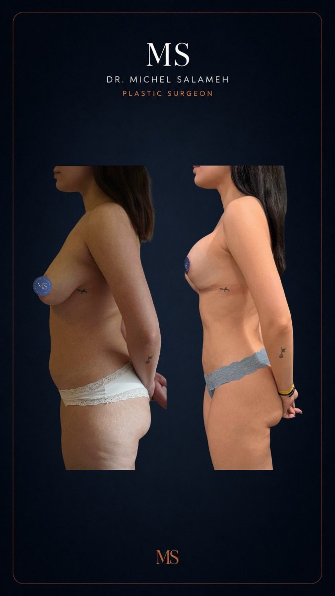 Resultados de liposucción 360 antes y después en Dr. Michel Salameh - Cirugía Plástica