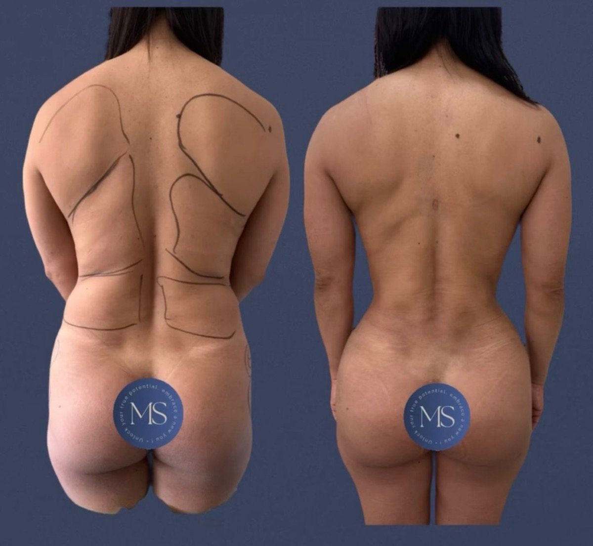 Resultados de liposucción 360 antes y después en Dr. Michel Salameh - Plastic And Aesthetic Surgery
