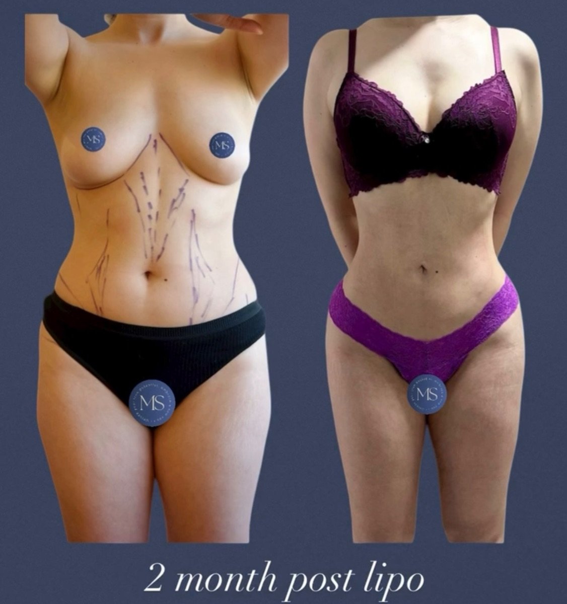 360 liposuction before and after results at Dr. Michel Salameh - Plastic And Aesthetic Surgery