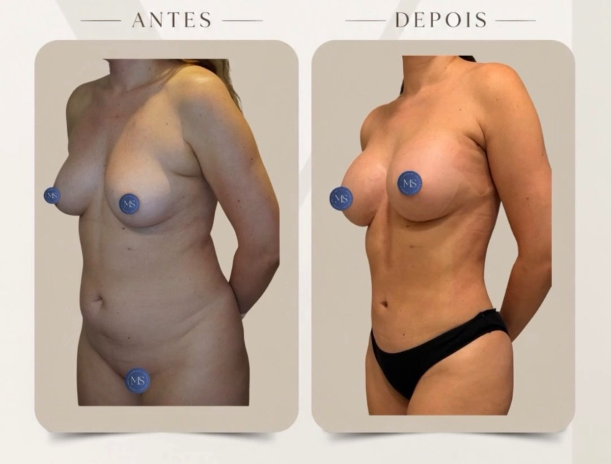 Resultados de lipoescultura 360 antes y después en Dr. Michel Salameh - Cirugía Plástica