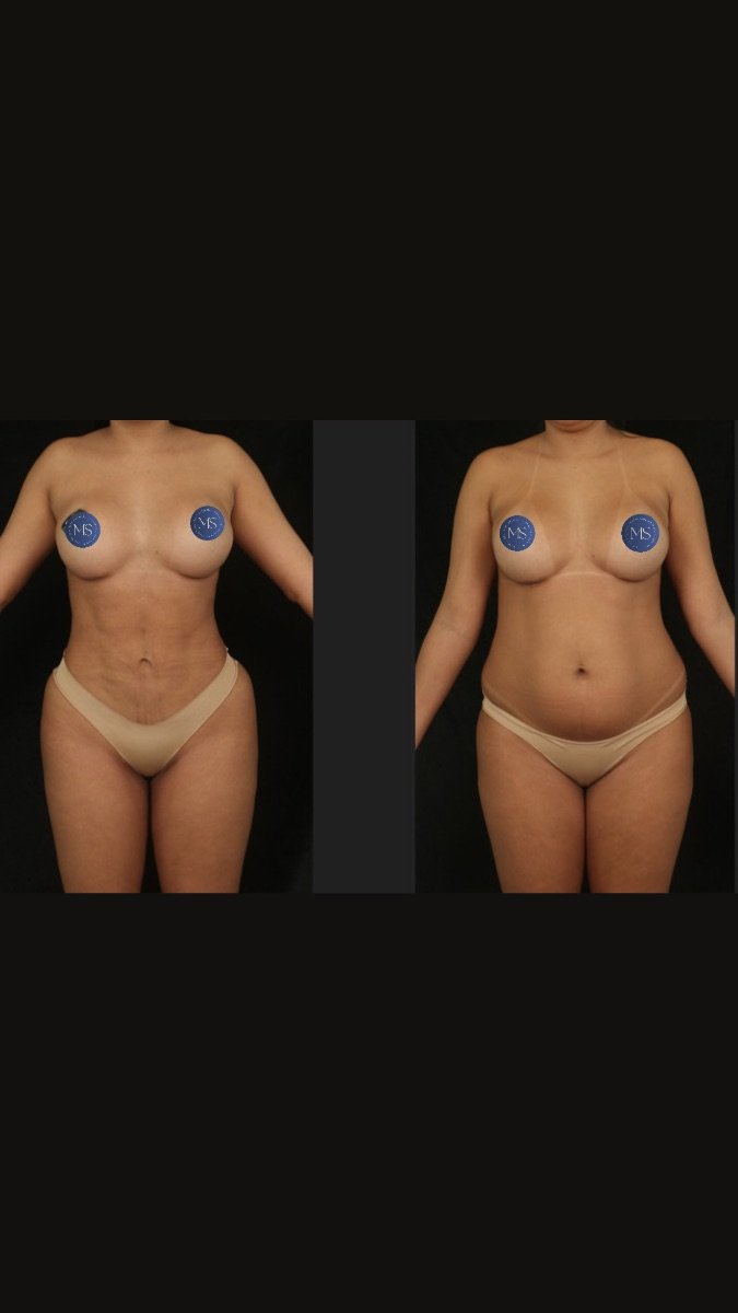 Resultados de liposucción 360 antes y después en Dr. Michel Salameh - Plastic And Aesthetic Surgery