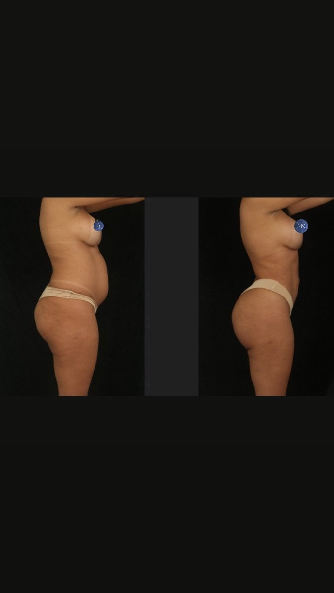 Resultado antes y después de liposucción 360 en Dr. Michel Salameh - Plastic And Aesthetic Surgery