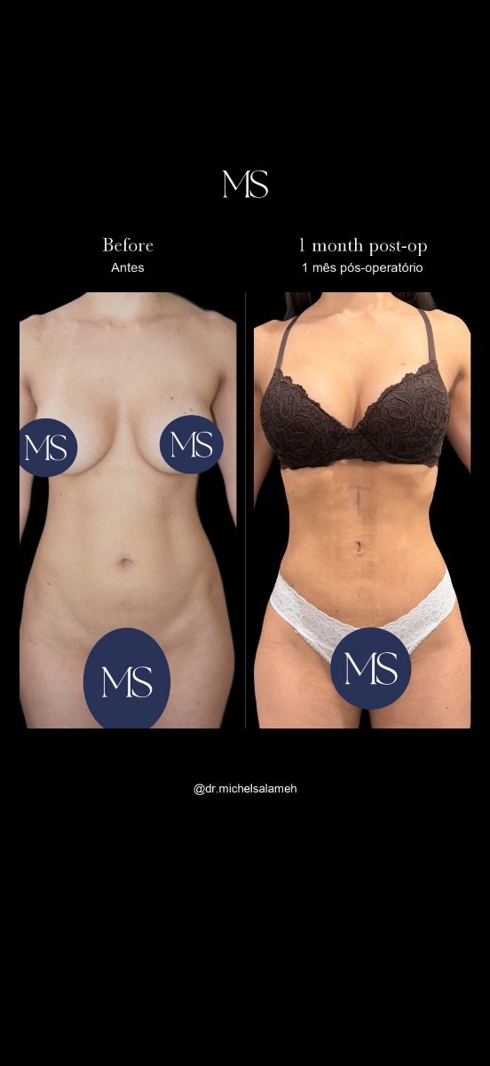 Resultados de lipoescultura 360 antes y después en Dr. Michel Salameh - Plastic And Aesthetic Surgery