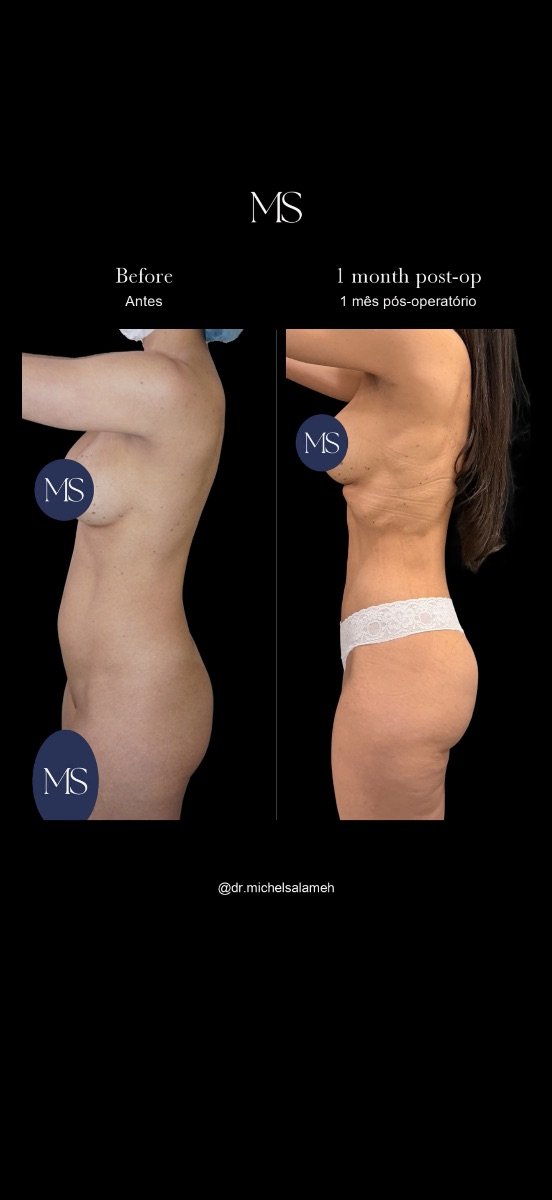 Resultados de liposucción 360 antes y después en Dr. Michel Salameh – contorno corporal visible