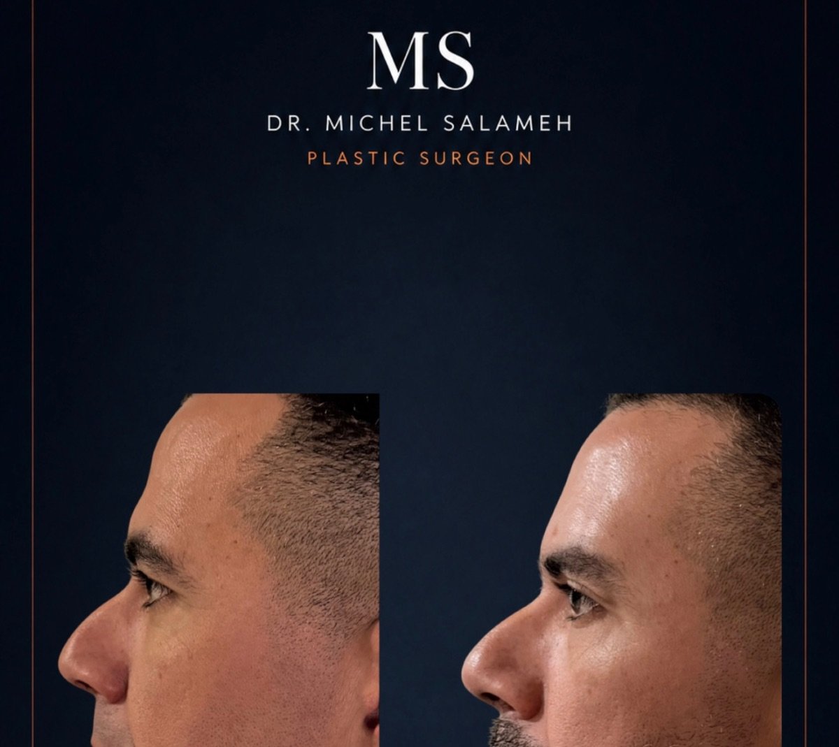 Resultados de lifting facial antes y después en Dr. Michel Salameh - Plastic And Aesthetic Surgery