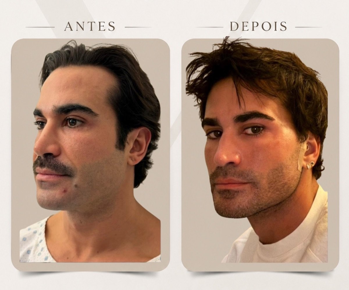 Resultados de lifting facial antes y después en Dr. Michel Salameh - Cirugía Plástica