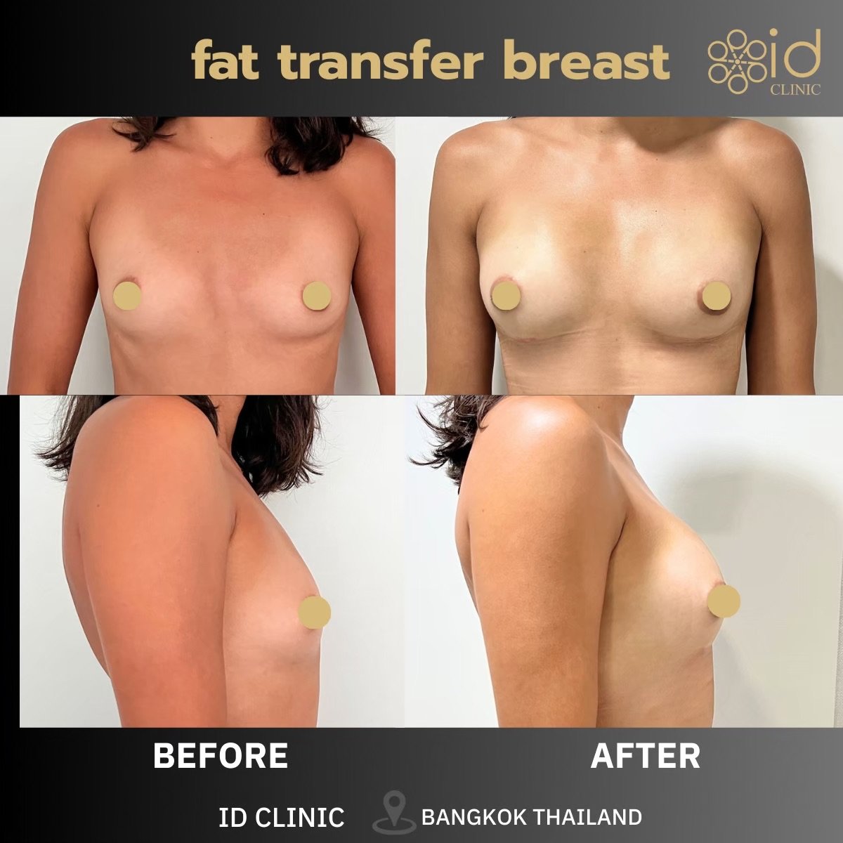 Resultados antes y después de aumento de senos con transferencia de grasa en ID Clinic Bangkok