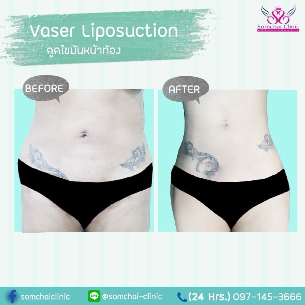 Before and after Vaser liposuction results at Somchai Clinic, abdomen contour improvement