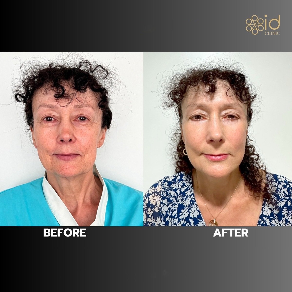 Resultados de lifting facial antes y después en ID Clinic Bangkok, rejuvenecimiento visible