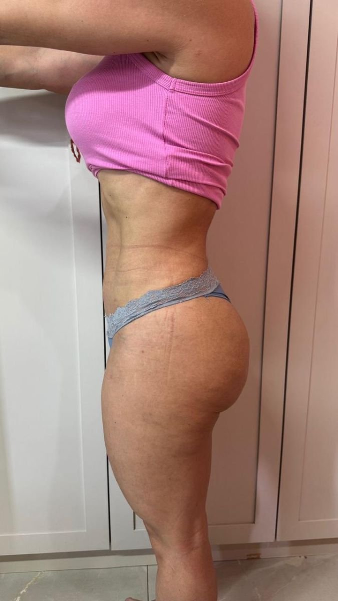 Liposuction 3 body areas result at Dr. Fabiano Arruda – plastic surgery (Goiânia), slimmer contour