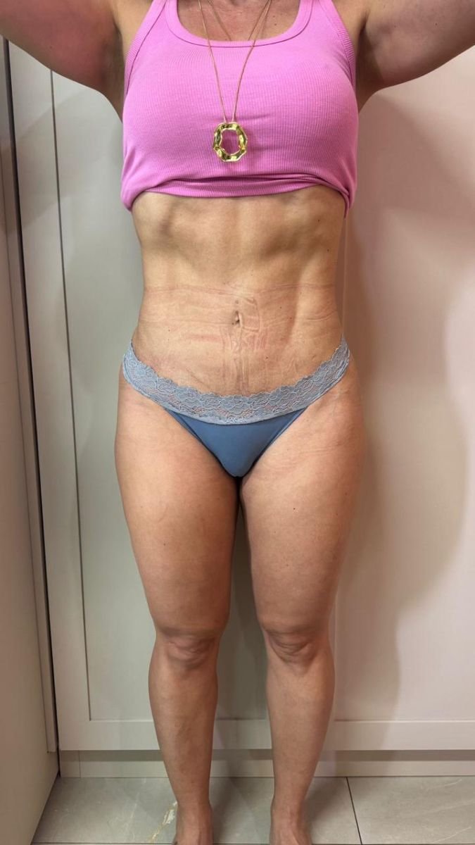 Liposuction 3 body areas result at Dr. Fabiano Arruda – plastic surgery (Goiânia), slimmer contour