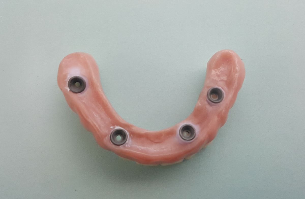 تعويض أسنان All-on-4 في SoftDentalCare Clinic، نتيجة استبدال الأسنان المتقدمة