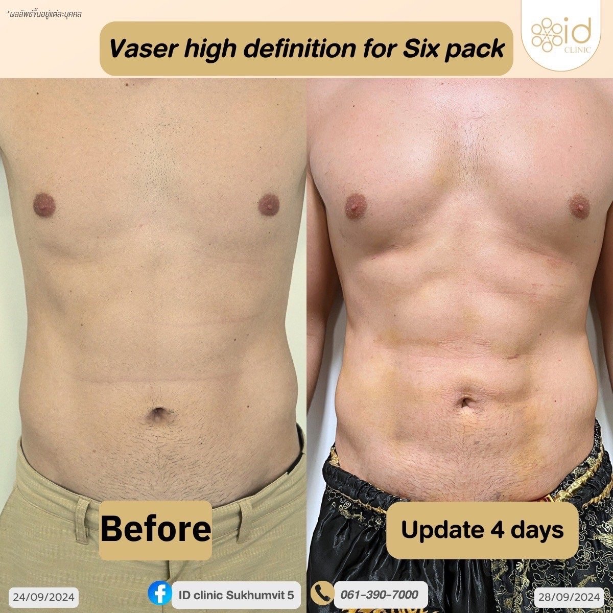 قبل وبعد شفط الدهون فايزر لعضلات البطن في ID Clinic Bangkok، نتائج واضحة للعضلات