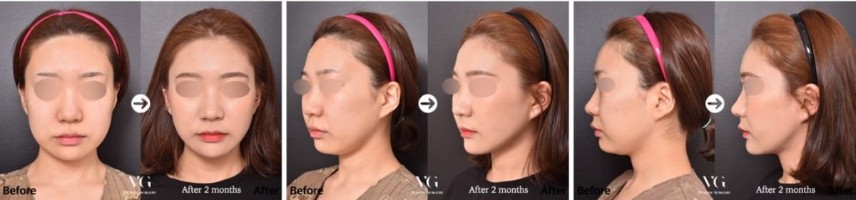 Antes y después de extracción de bolas de Bichat en VG Plastic Surgery – mejillas más delgadas