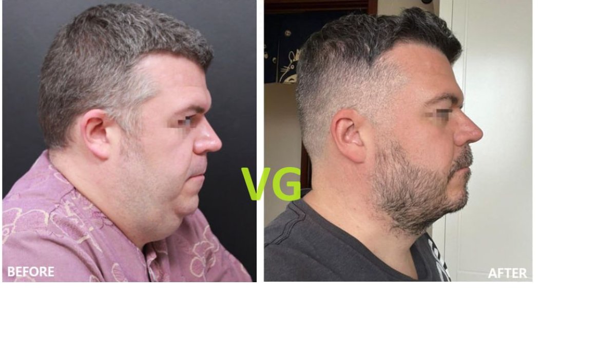 Antes y después de extracción de grasa bucal en VG Plastic Surgery – rostro más delgado