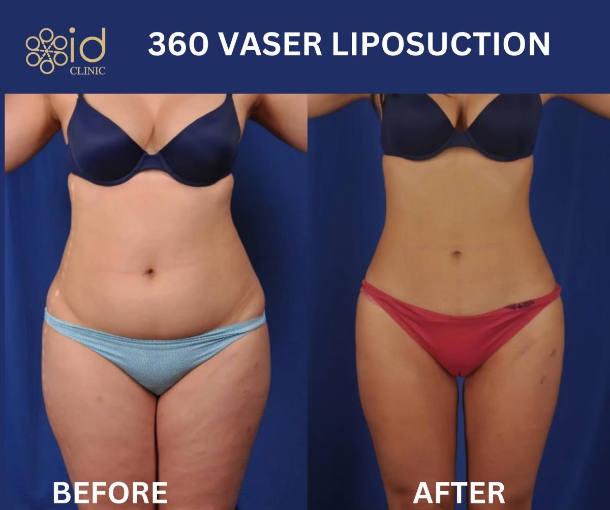 Resultados antes y después de liposucción 360 VASER en ID Clinic Bangkok, mejora corporal
