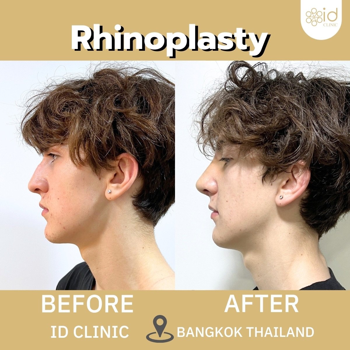 نتيجة قبل وبعد عملية تجميل الأنف المفتوحة في ID Clinic Bangkok وتحسن شكل الأنف