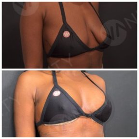 Standard Breast augmentation with Motiva® Ergonomix® breast implants - photo 4