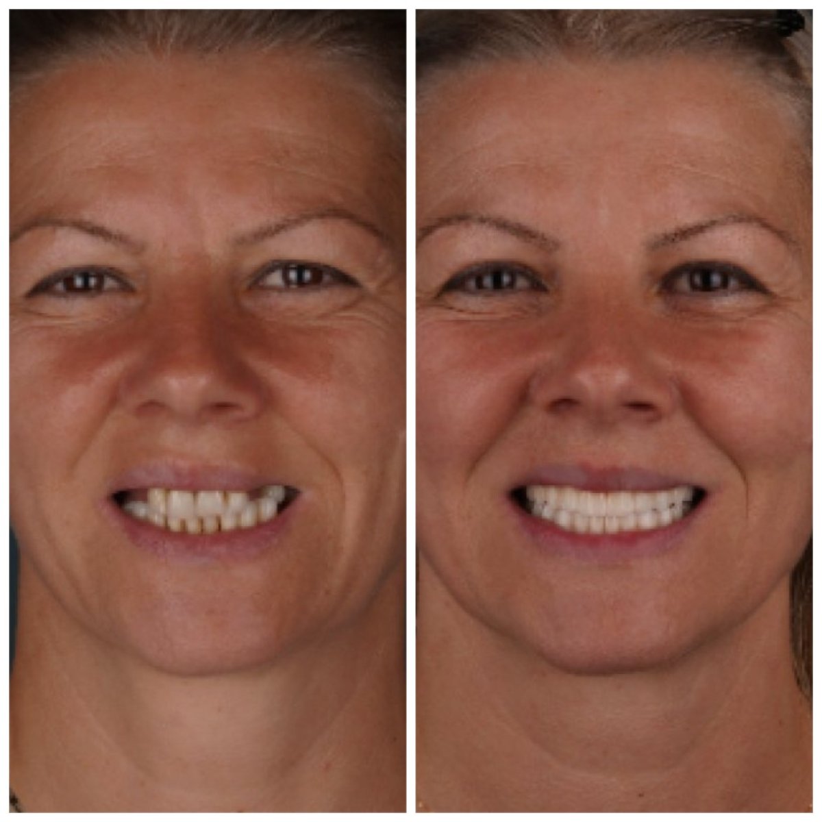 Before and after All-on-4 dental implants result at Esnan Dental Clinics, smile restoration