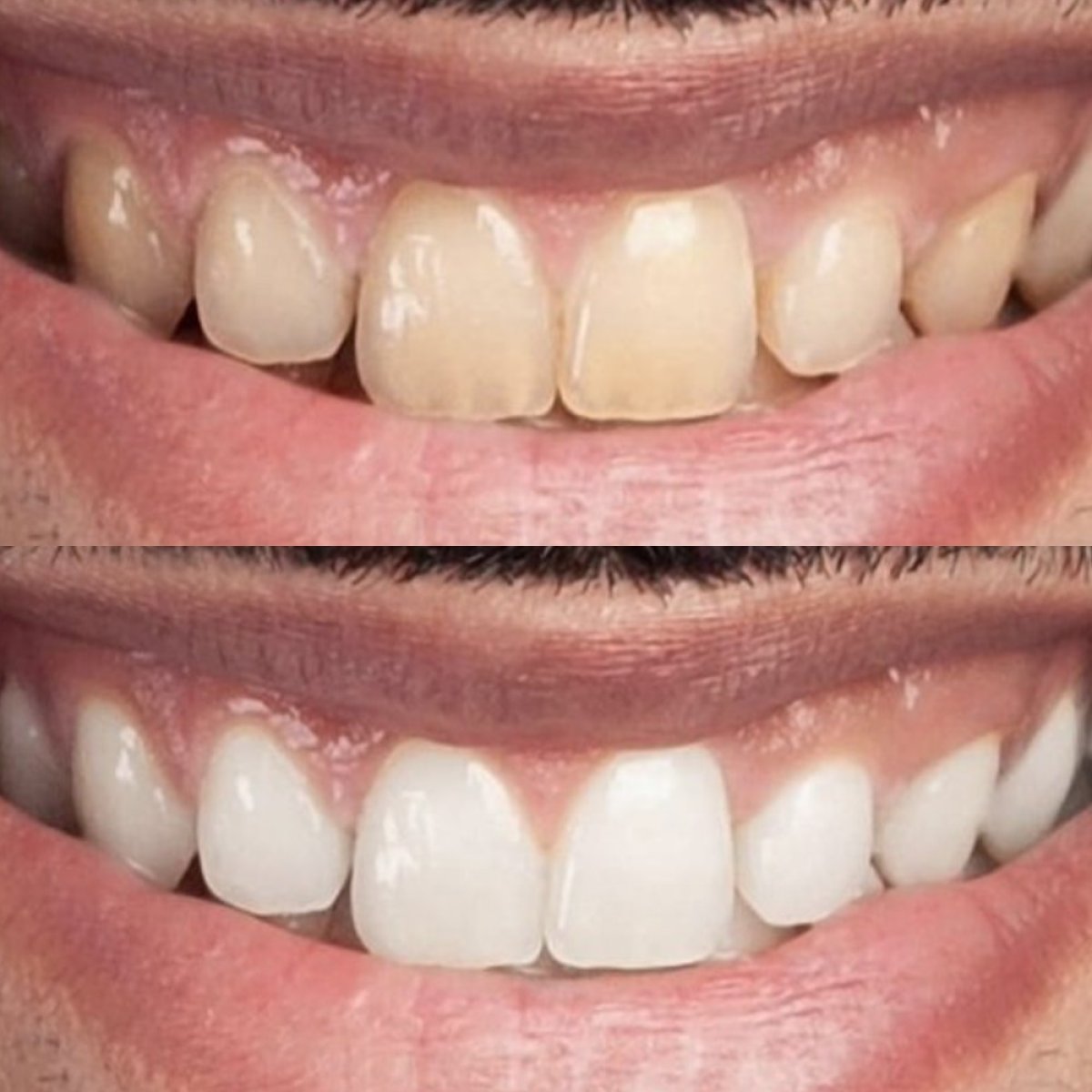 Before and after tooth whitening results at Punta Cana dentist odontologia familiar, brighter smile