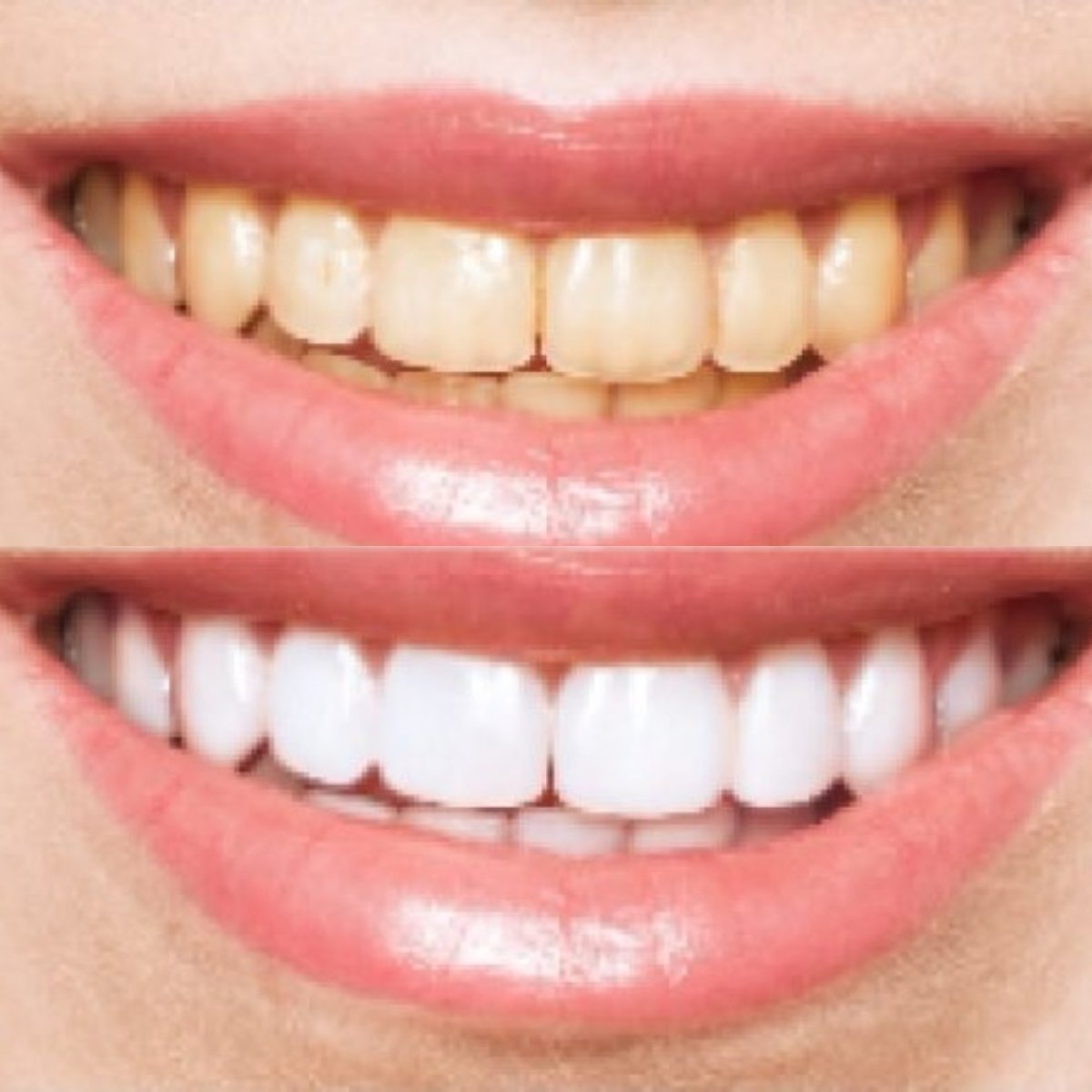 Resultados de blanqueamiento dental antes y después en Punta Cana dentist odontologia familiar