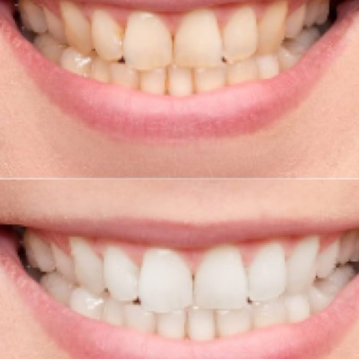 Before and after tooth whitening results at Punta Cana dentist odontologia familiar, brighter smile