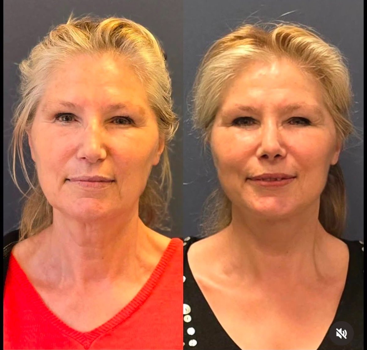before and after photo