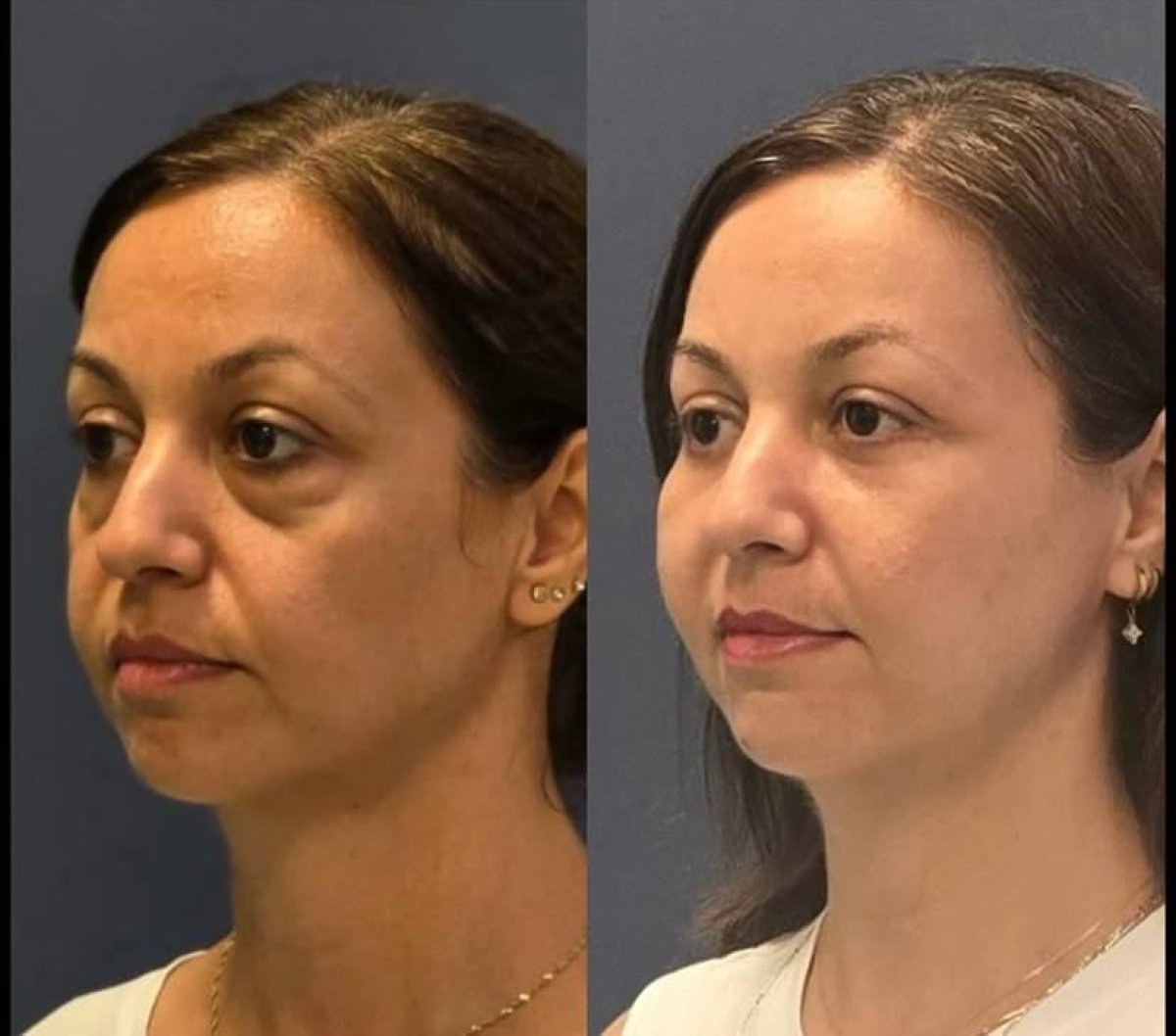 before and after photo