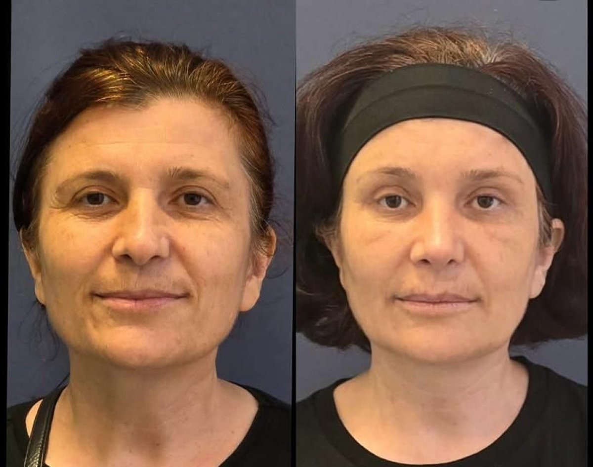 before and after photo