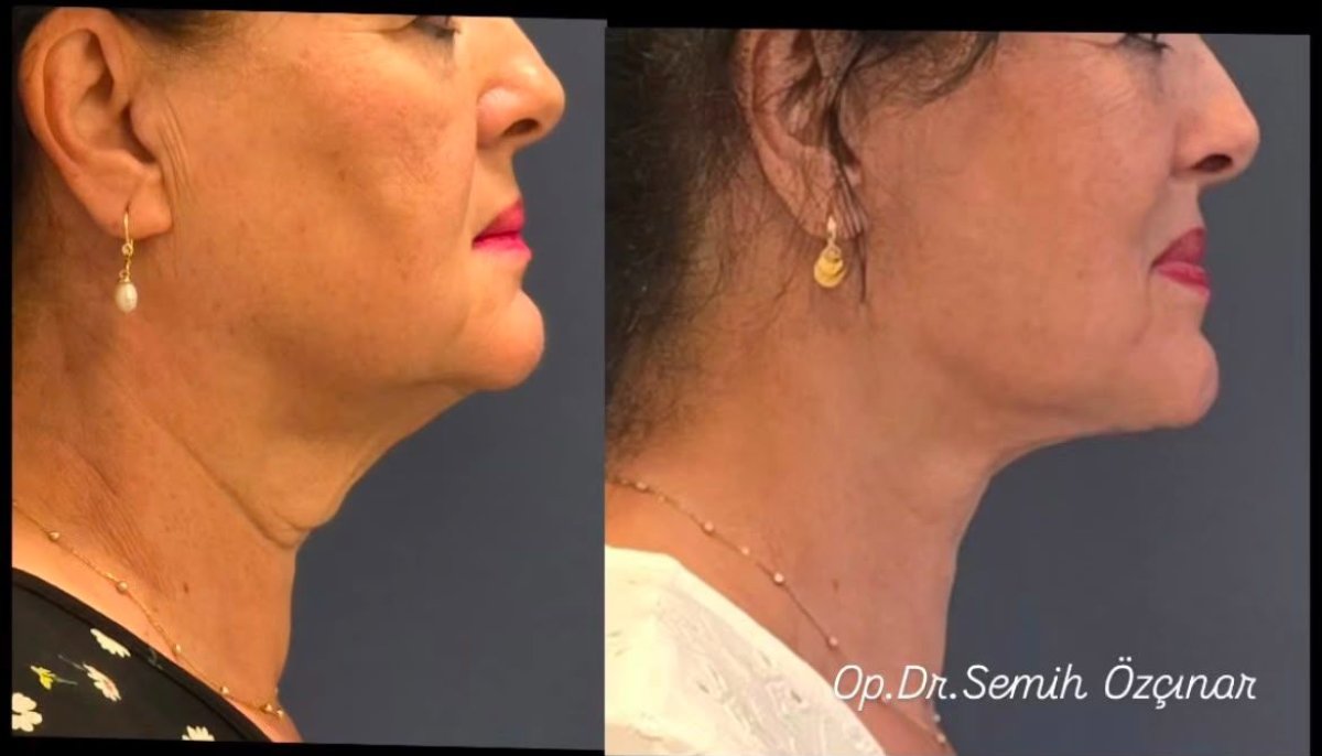 before and after photo