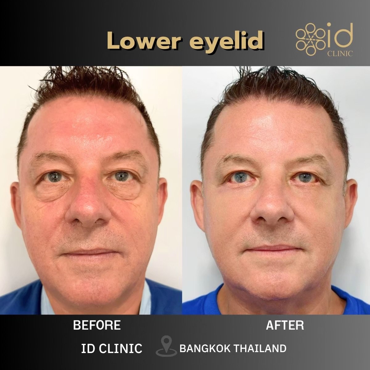 Resultados de blefaroplastia inferior en ID Clinic Bangkok, reducción de bolsas bajo los ojos