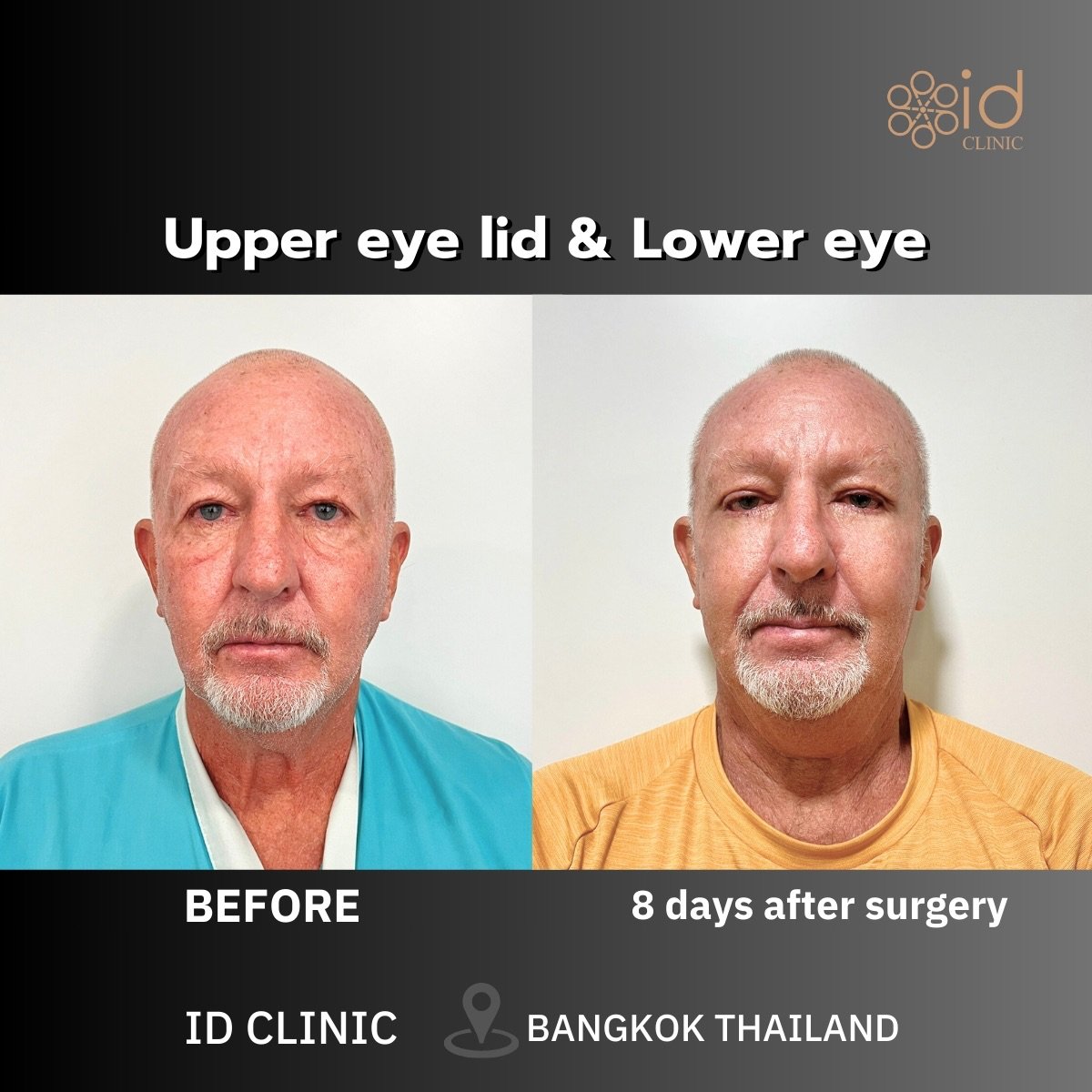 Resultados de blefaroplastia superior e inferior en ID Clinic Bangkok, 8 días después
