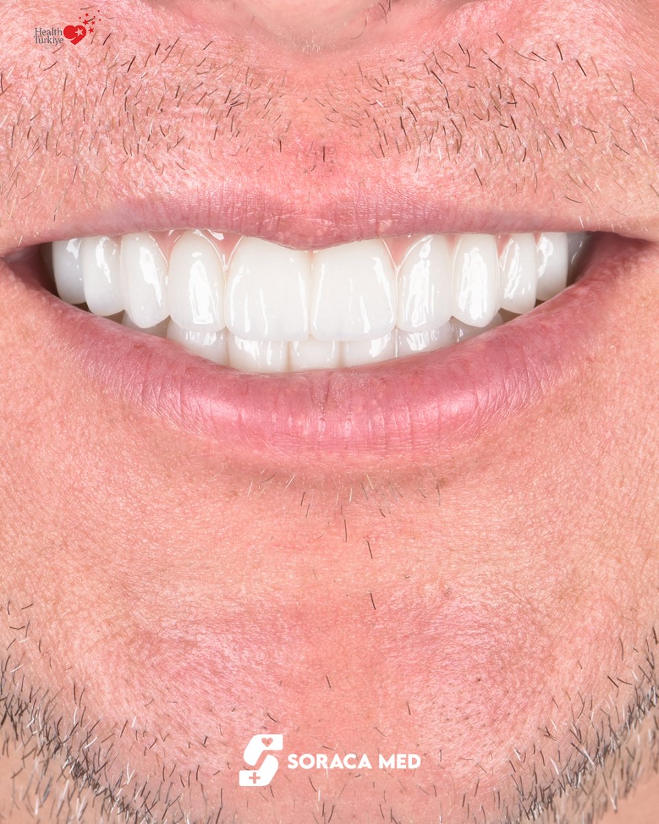 Resultado de Hollywood Smile en Soraca Med: dientes blancos y alineados tras carillas dentales