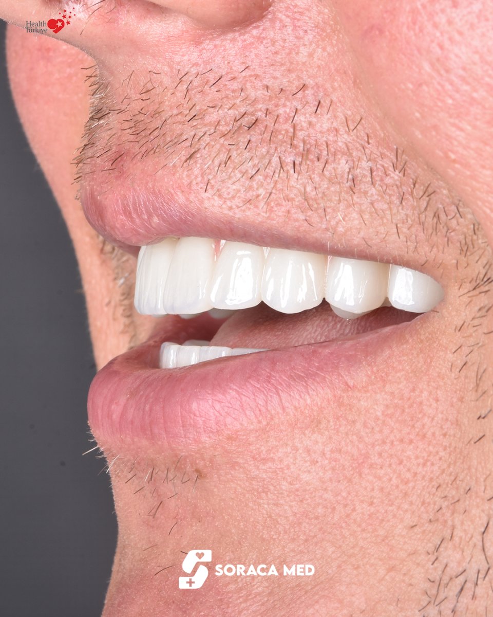Resultado de Hollywood Smile en Soraca Med: dientes blancos y alineados tras carillas dentales
