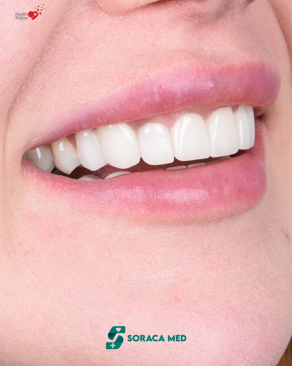 Resultado de Hollywood Smile en Soraca Med: dientes blancos y alineados tras carillas dentales