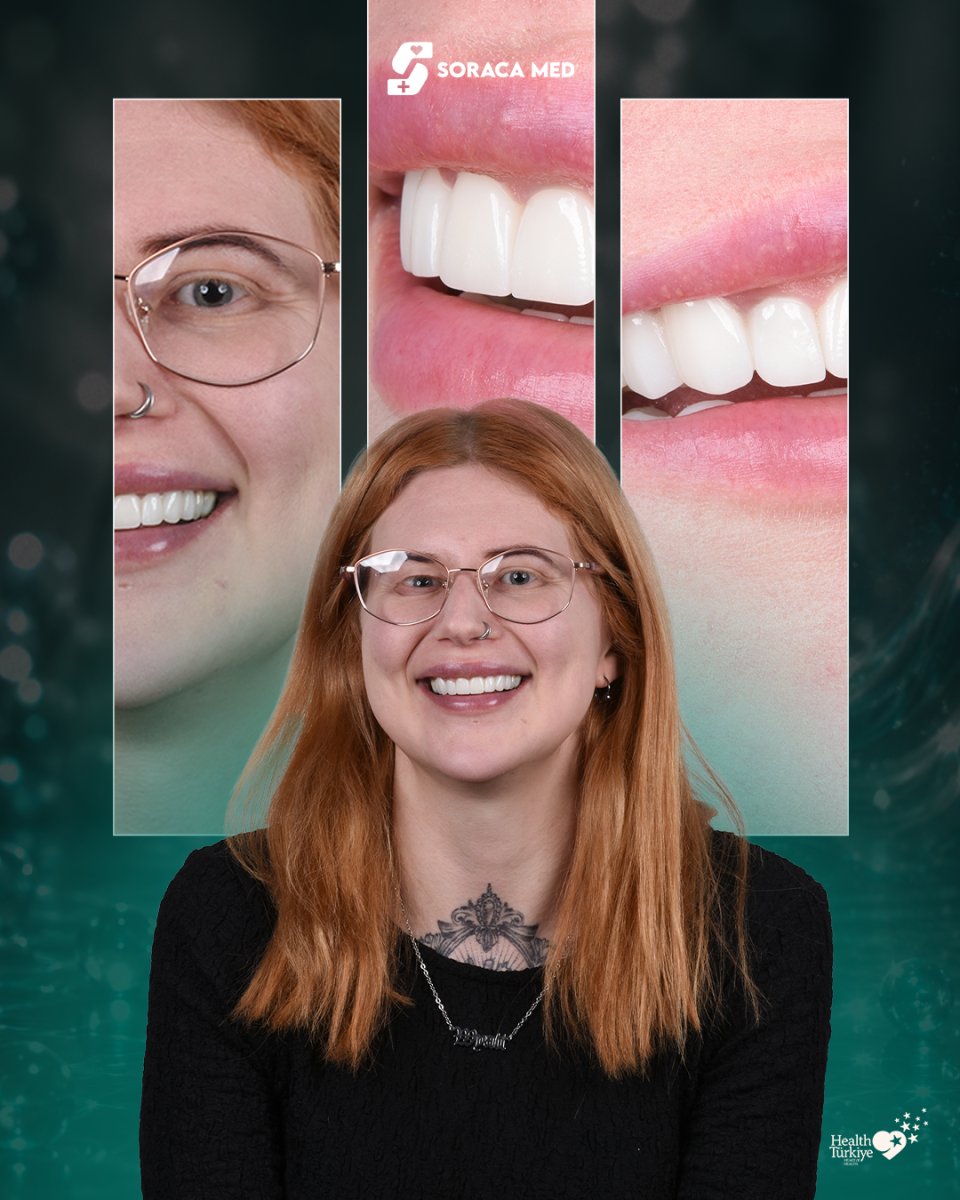 Resultados de Hollywood Smile en Soraca Med: dientes blancos y alineados tras carillas