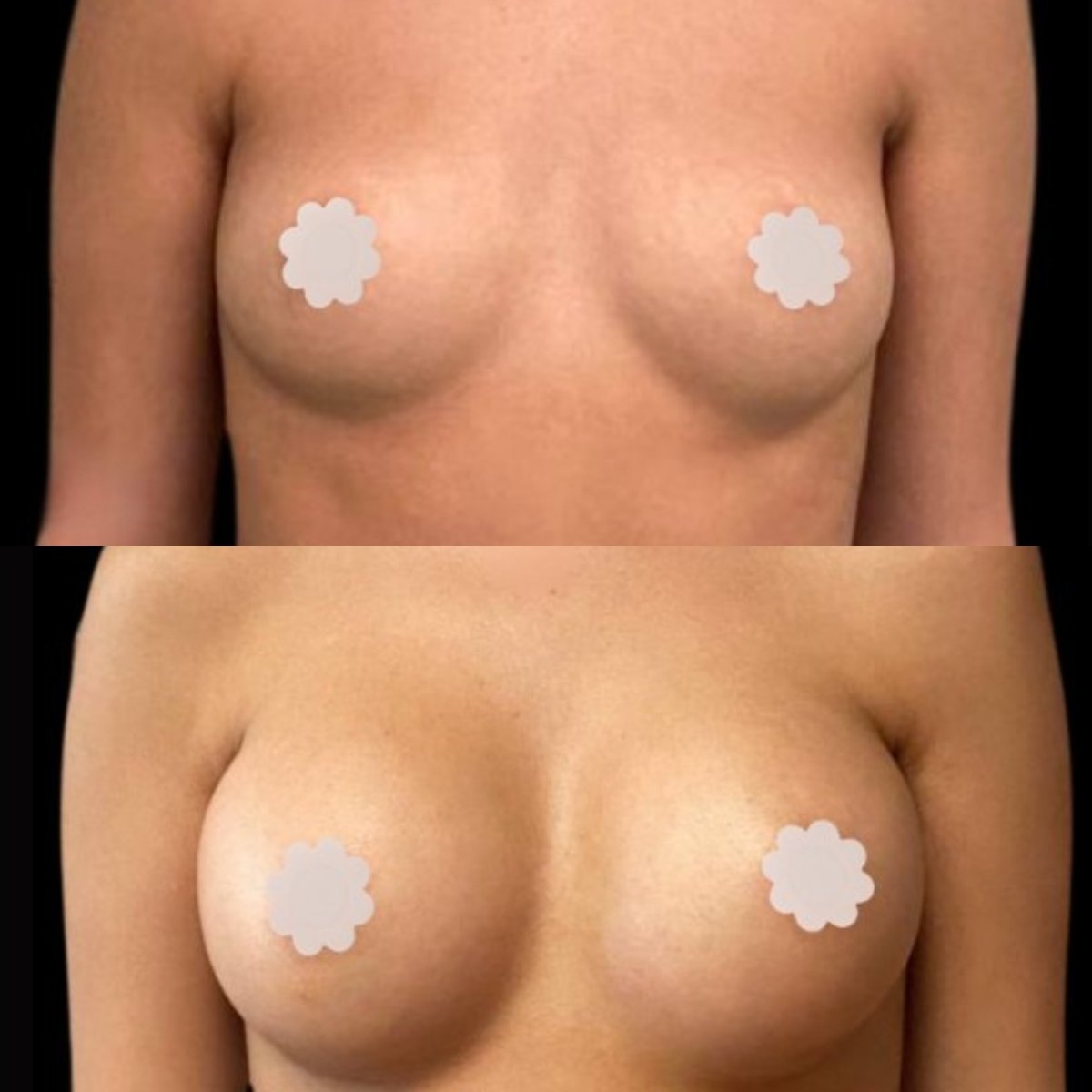 Resultados antes y después de aumento de senos en EDEN AESTHETICS Clinic, forma mejorada