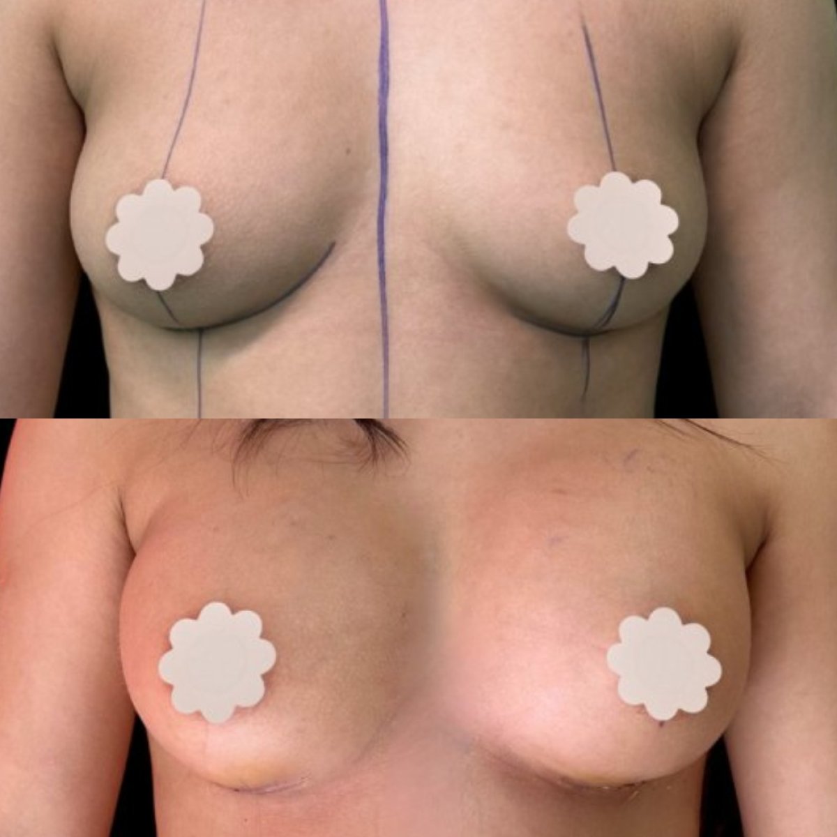 Resultados antes y después de aumento de senos en EDEN AESTHETICS Clinic, forma más llena