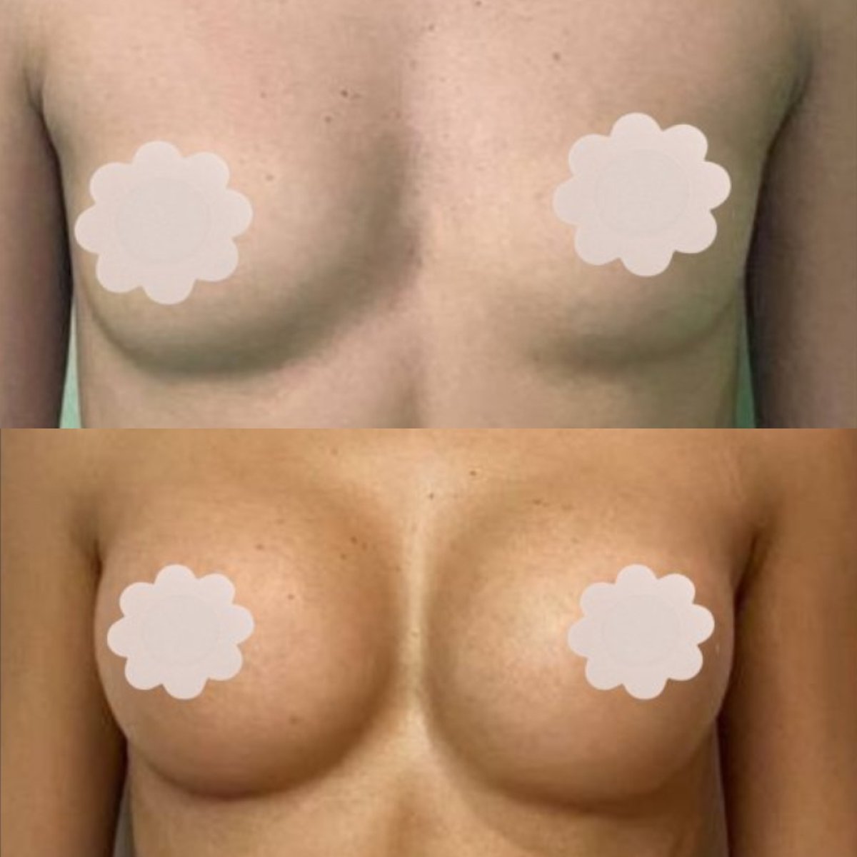 Resultados antes y después de aumento de senos en EDEN AESTHETICS Clinic, forma mejorada