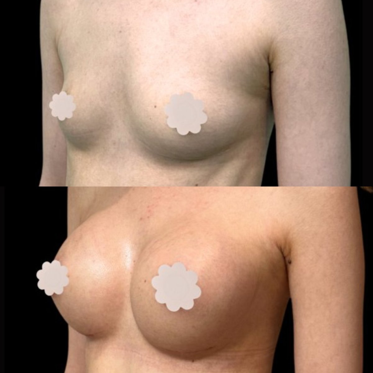 Resultados antes y después de aumento de senos en EDEN AESTHETICS Clinic, mayor volumen mamario