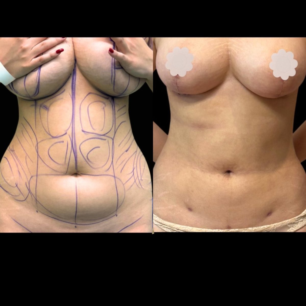نتائج قبل وبعد عملية تجميل الأم في EDEN AESTHETICS Clinic – تحسين شكل الجسم