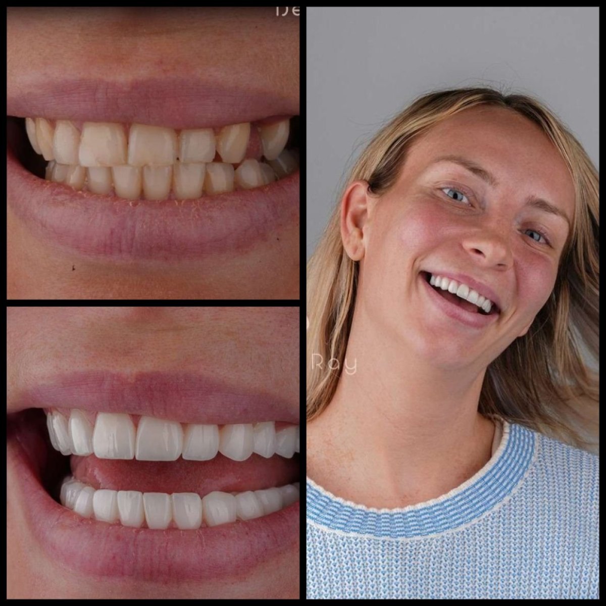Resultados de Hollywood Smile antes y después en Dentaray Clinic – dientes más blancos y parejos