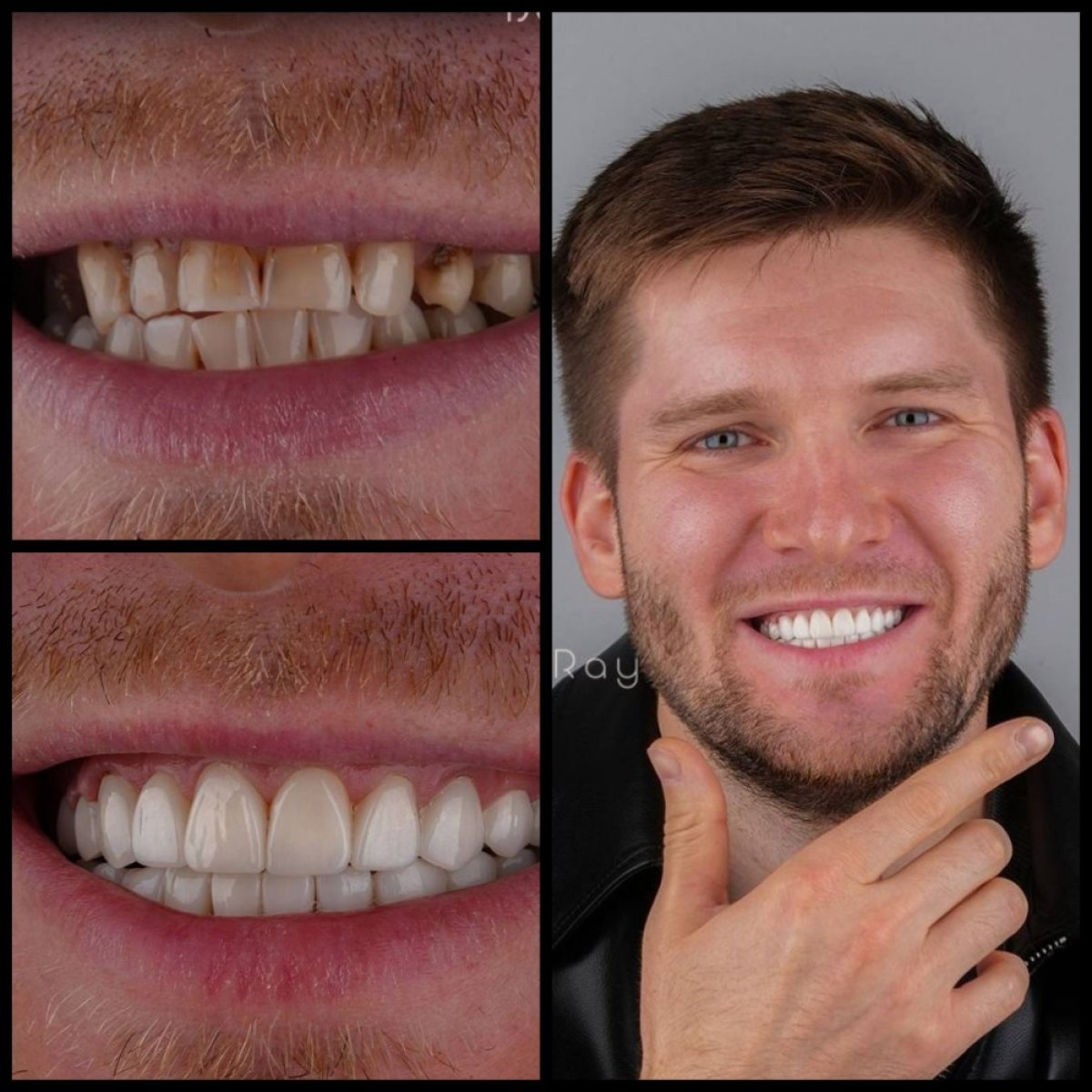 نتائج ابتسامة هوليوود قبل وبعد في عيادة Dentaray – تحول ملحوظ في الابتسامة