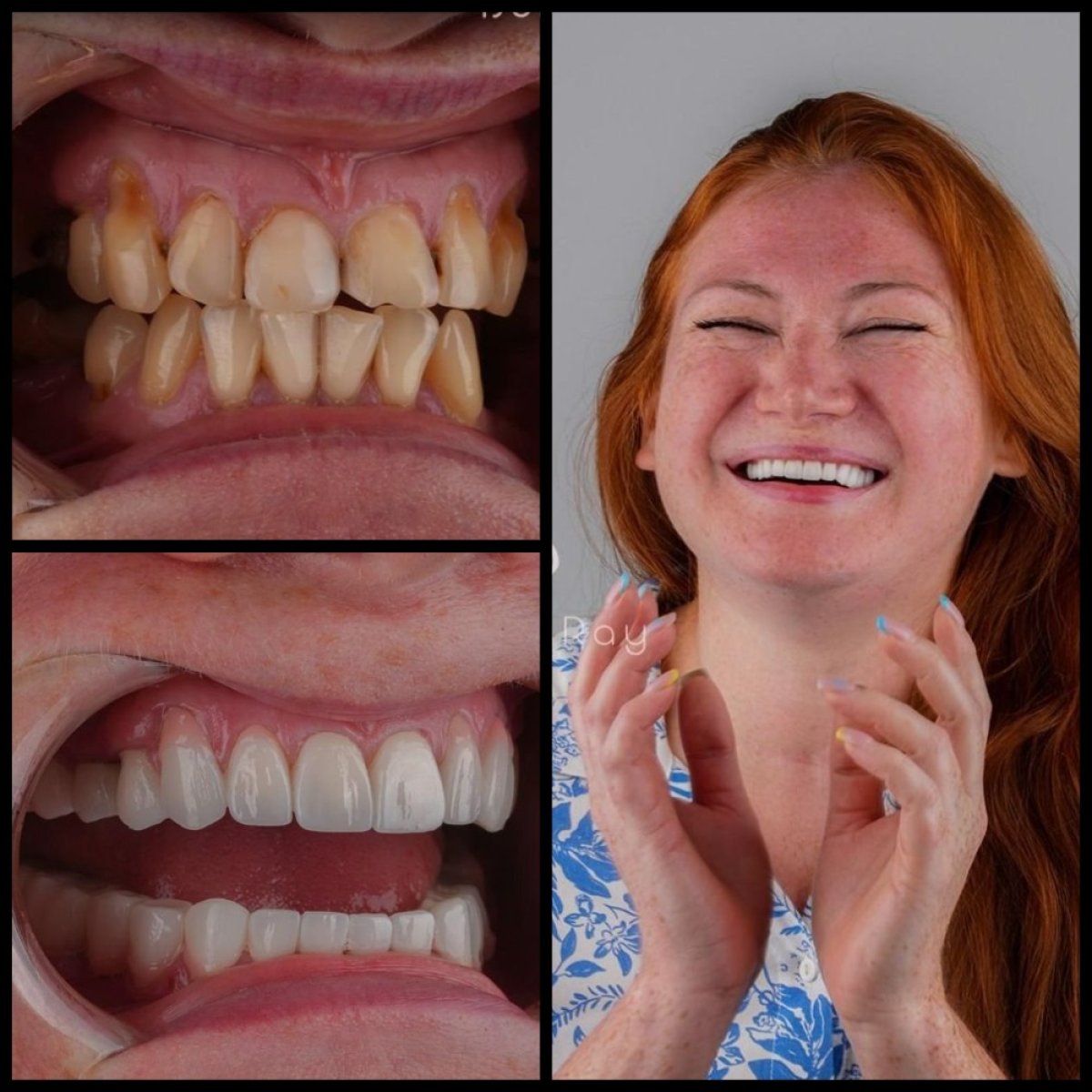 نتائج قبل وبعد ابتسامة هوليود في عيادة Dentaray، تجميل الابتسامة بالفينير