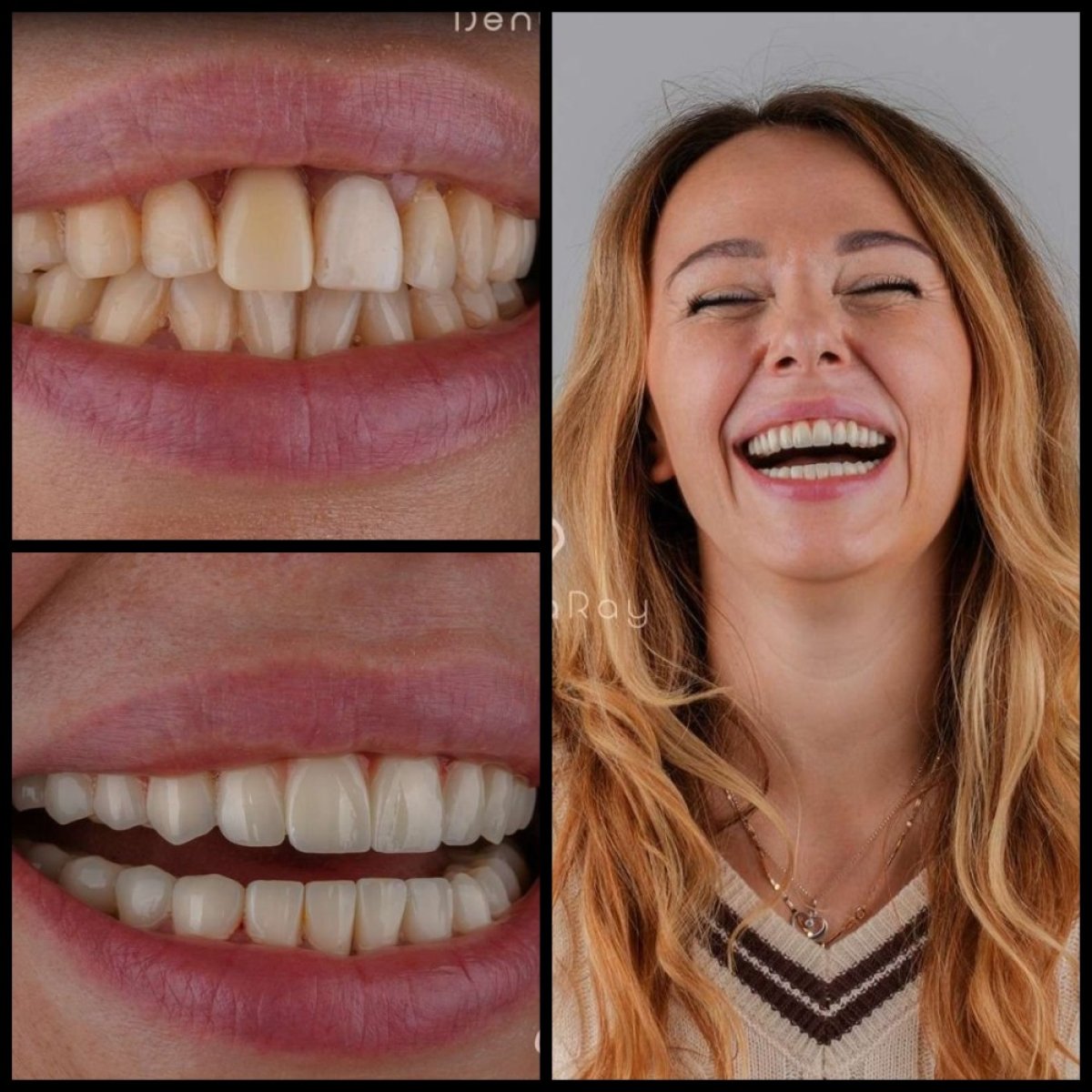 نتائج ابتسامة هوليود قبل وبعد في عيادة Dentaray – تحول ملحوظ في الابتسامة