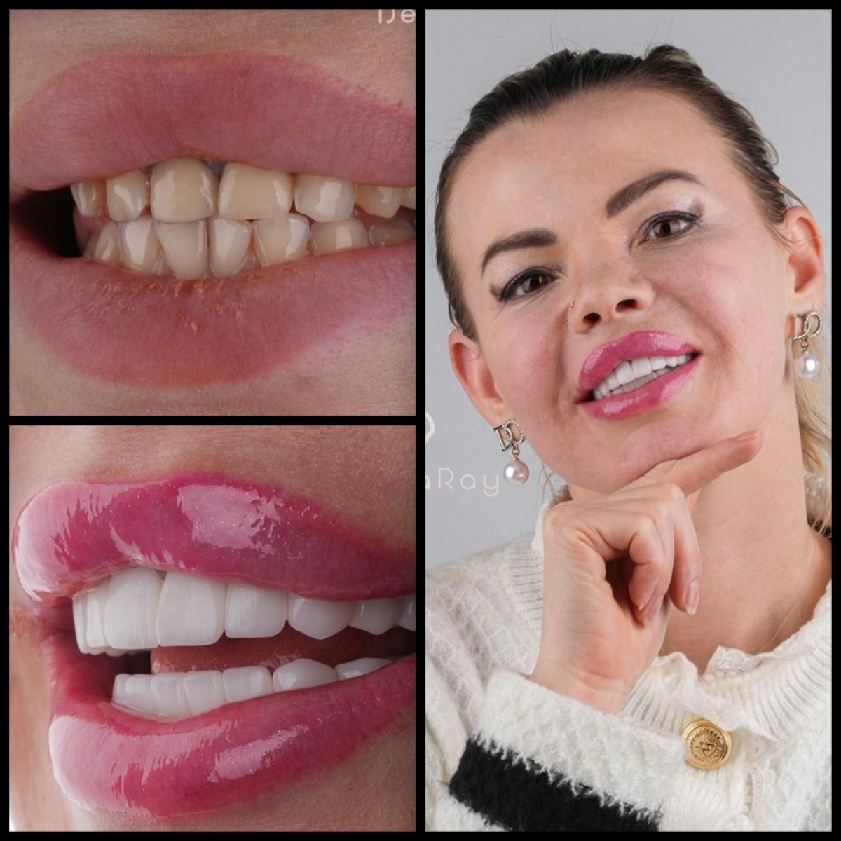 نتائج قبل وبعد ابتسامة هوليود في عيادة Dentaray – قشور الأسنان لتحسين الابتسامة