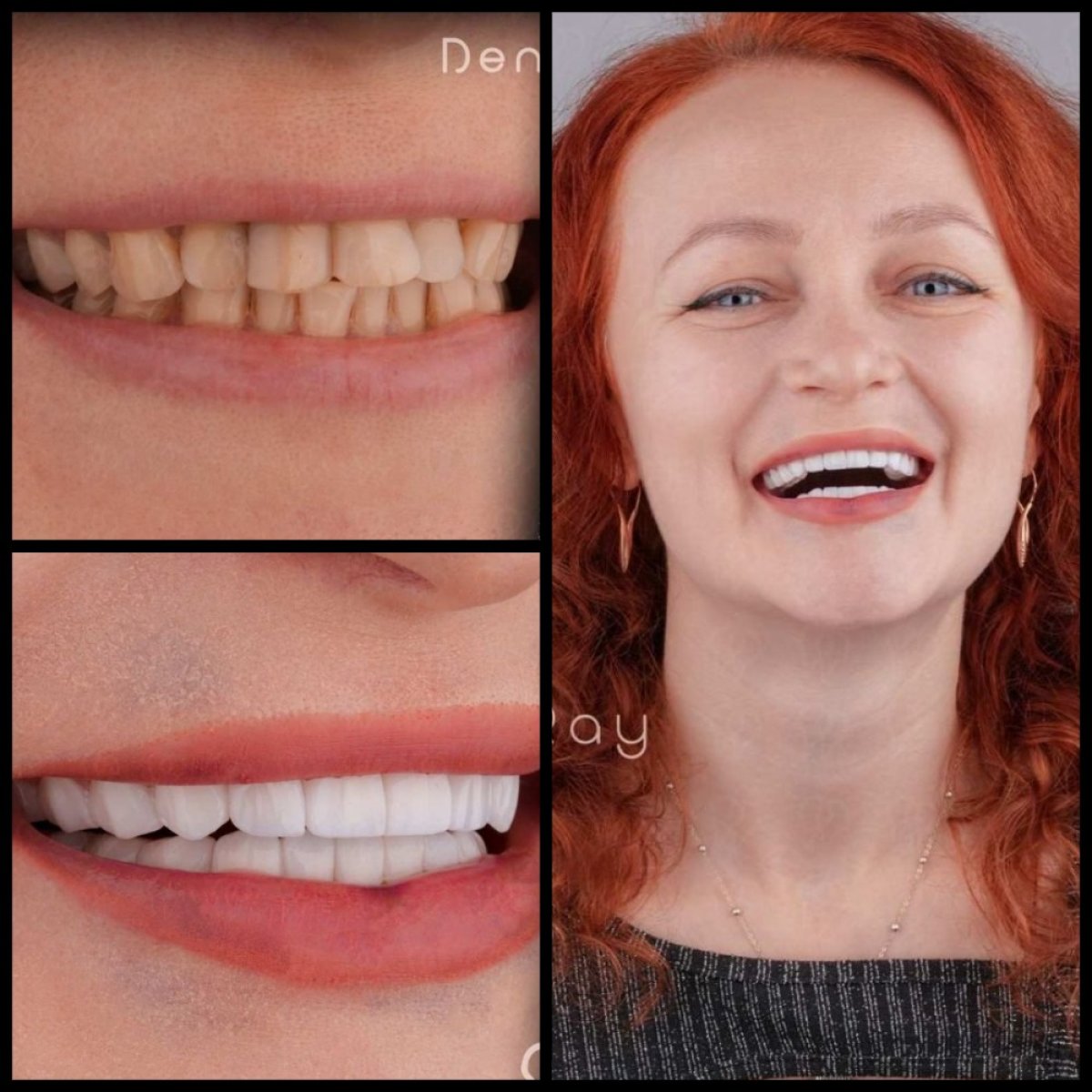 نتائج ابتسامة هوليود قبل وبعد في عيادة Dentaray – قشور الأسنان وتجميل الابتسامة